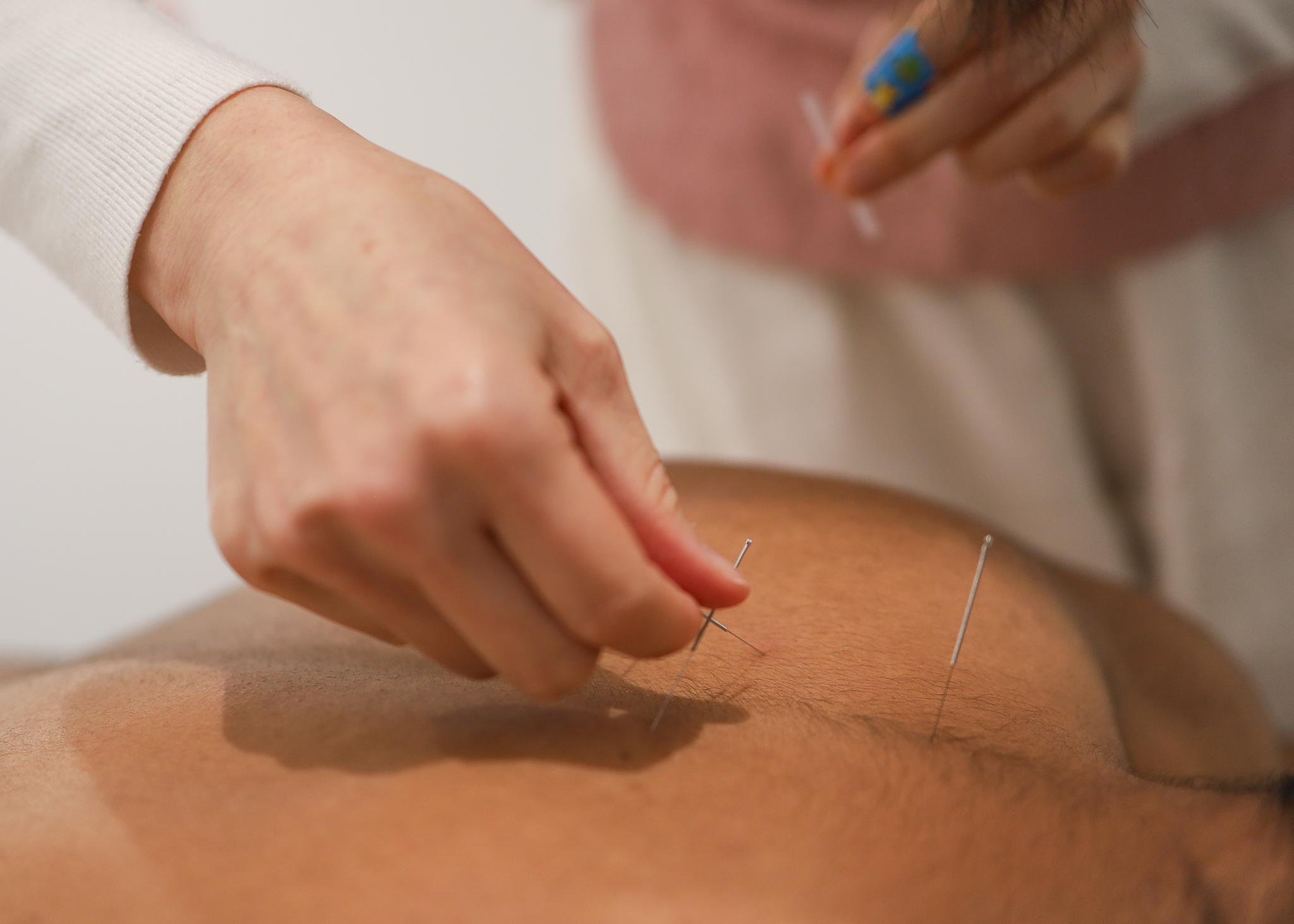 Acupuncture Treatment